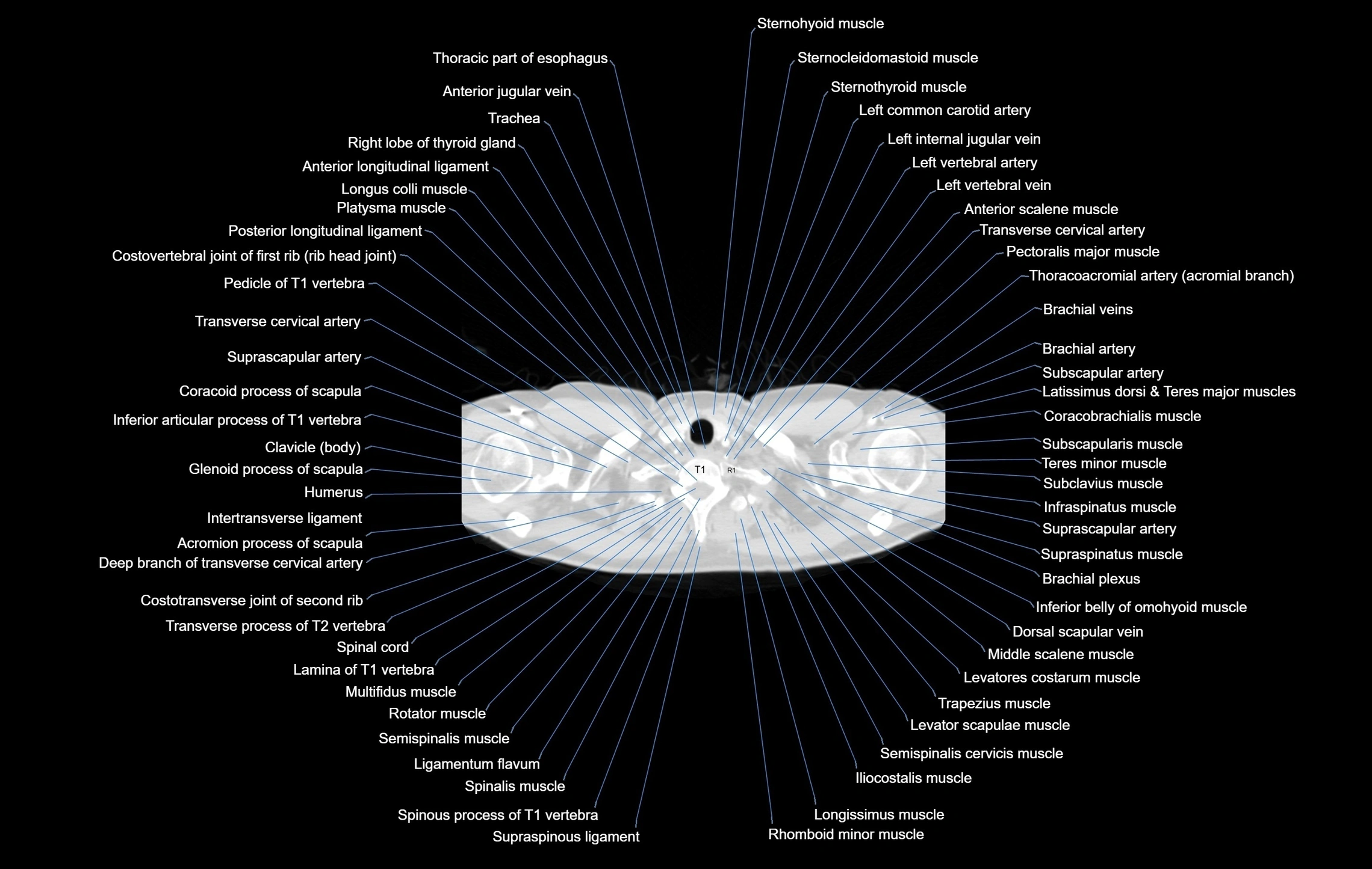 CT chest (thorax) labelled axial cross sectional anatomy radiology image-00003.webp